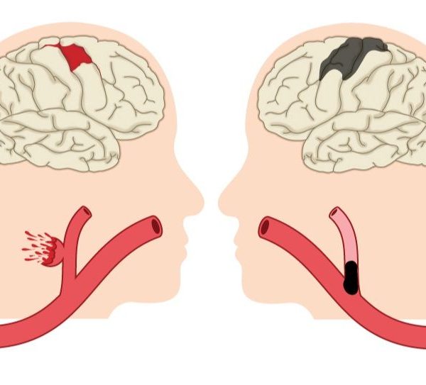 انواع سکته مغزی چیست؟