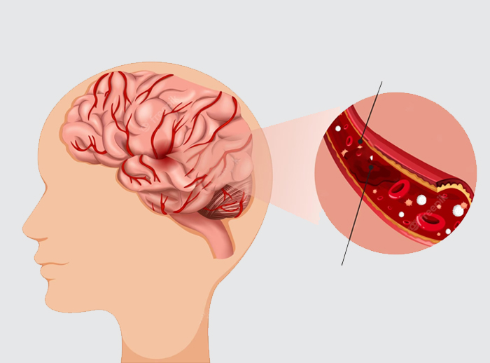 سکته مغزی ایسکمیک