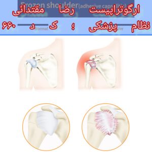کاردرمانی شانه منجمد 