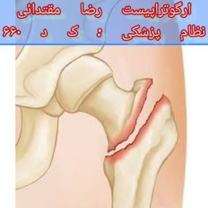 فیزیوتراپی بعد از شکستگی ران 
