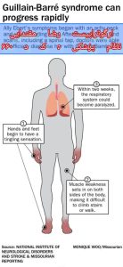 گیلن باره چیست ؟ 
