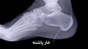 فیزیوتراپی در سید خندان خارپاشنه