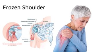 فیزیوتراپی شانه منجمد در سید خندان